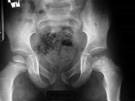 Последние твиты от perthes kids foundation (@pertheskids). Perthes' Disease. Causes, symptoms, treatment Perthes' Disease