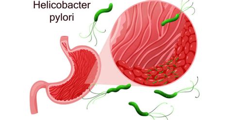 H Pylori Infection Causes Symptoms Treatment