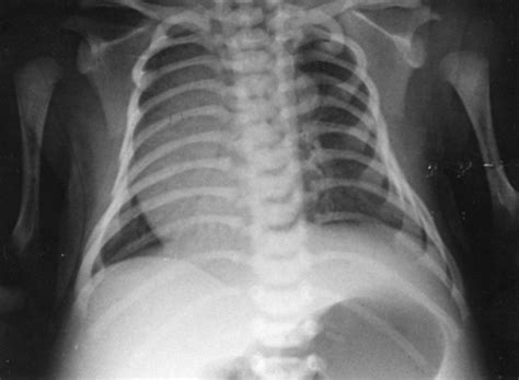 A Chest X Ray Revealed Dextrocardia And A Round Soft Tissue Shadow The