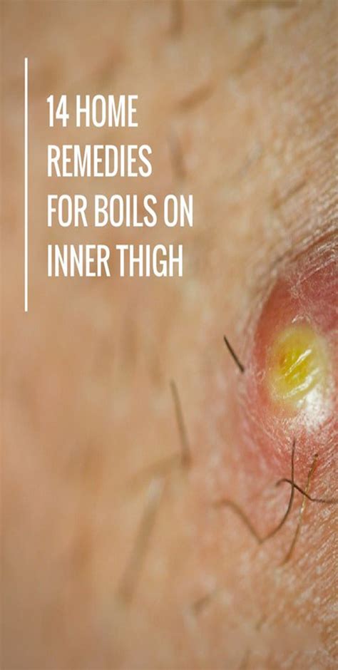 A Boil Is A Common Skin Problem That May Occur At Any Part Of The Body