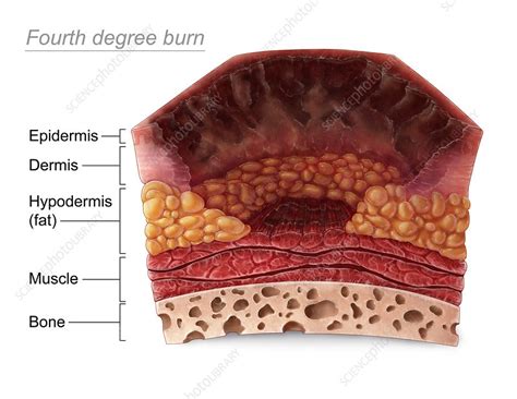 Fourth Degree Burn Diagram
