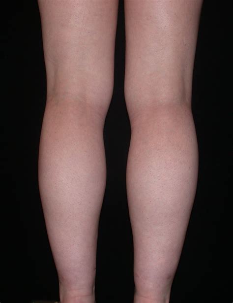 Calf And Ankle Liposuction Example Seattle Lipo With Dr Salemy