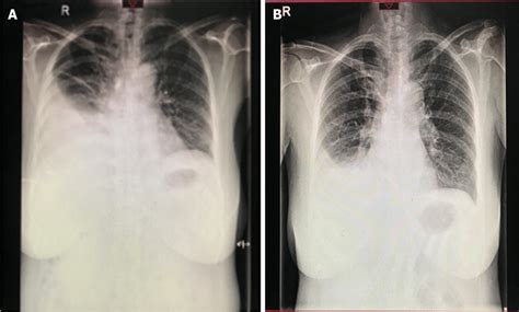 X Ray Photographs Demonstrating Blunting Of The Right Costophrenic
