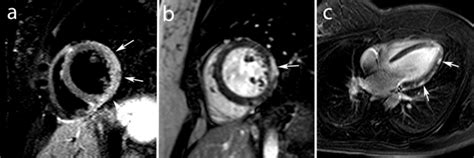 Most of the time, it is caused by an infection that reaches the heart. MRI study in an 18 year old male with acute chest pain in ...