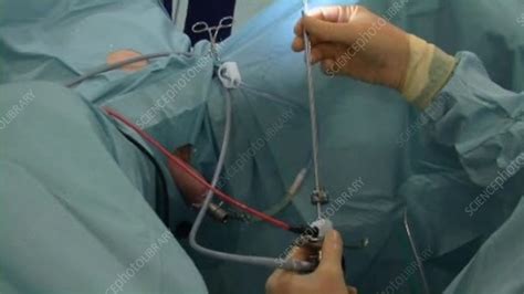 Bladder Evacuation During A Turp Biopsy Stock Video Clip K0038586