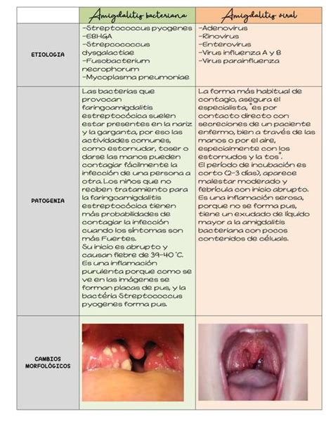 Amigdalitis Cuadro Comparativo Udocz