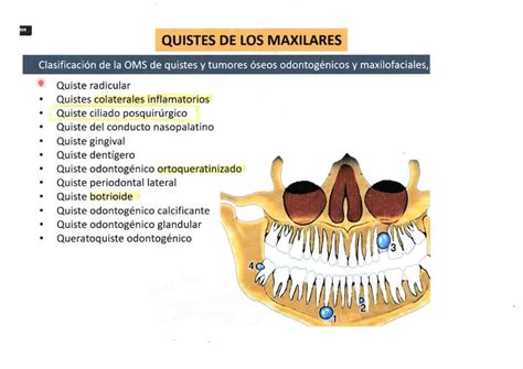 Clasificación De Quistes En Los Maxilares Douglass Drddouglass85