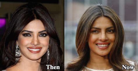 Priyanka Chopra Plastic Surgery Before And After