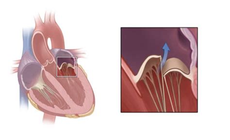 Diagnosis And Treatment Of Mitral Valve Prolapse Vinmec