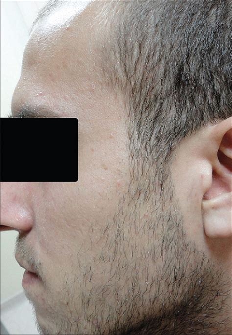 Ipsilateral Facial Paralysis And Steroid Acne Indian Journal Of