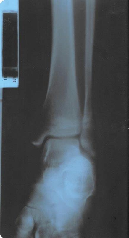 Fibula Stress Fractures The Foot And Ankle Online Journal