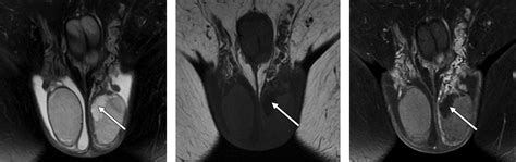 Mri Of Patients With Suspected Scrotal Or Testicular Lesions Diagnostic Value In Daily Practice