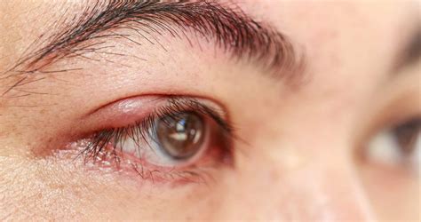 Eye Stye What Is It Causes And Treatment