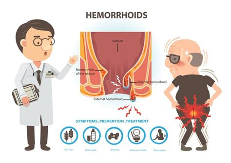 Can You Get A Va Rating For Hemorrhoids 2023 Guide