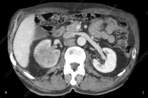 Kidney Mass Ct Scan