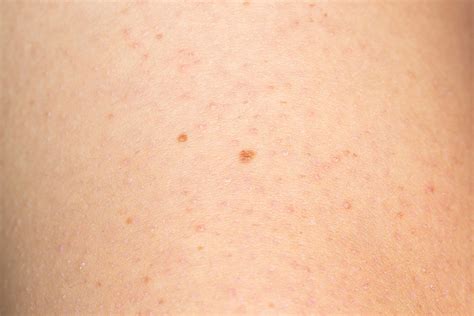 Keratosis Symptoms Clear Skin Clinic