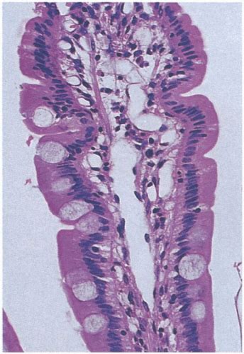 The Nonneoplastic Small Intestine Abdominal Key