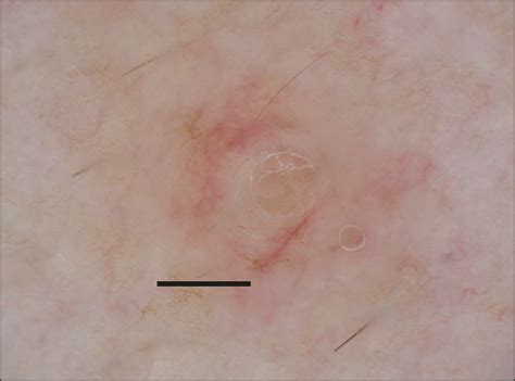 Dermoscopy Of Molluscum Contagiosum Infectious Diseases Jama