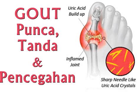Maybe you would like to learn more about one of these? Punca, Tanda dan Pencegahan Gout