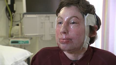 Exclusive Pc Burns Victim Proud Of Remarkable Recovery Itv News Granada