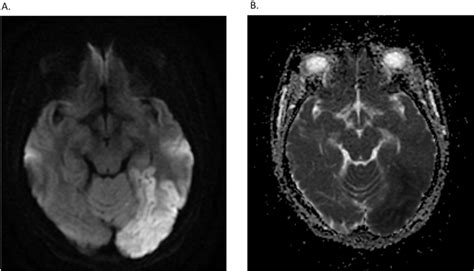 A Magnetic Resonance Imaging Showed Diffusion Restriction In Left