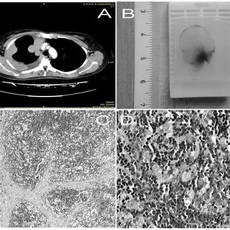 Ab Two Cases Of Malignant Pleural Mesothelioma Contrast Enhanced Ct