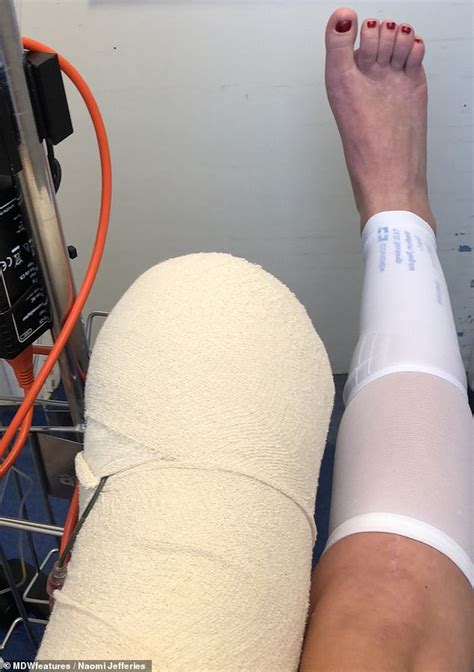 Physiotherapist Has Leg Amputated After 17 Surgeries To Try And Save Limb Following A Car Crash