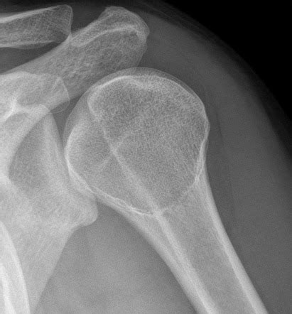 Pseudocyst Of The Humerus Radiology Reference Article Radiopaedia Org