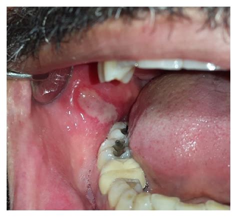 Ulcers By Oral Pemphigus Vulgaris