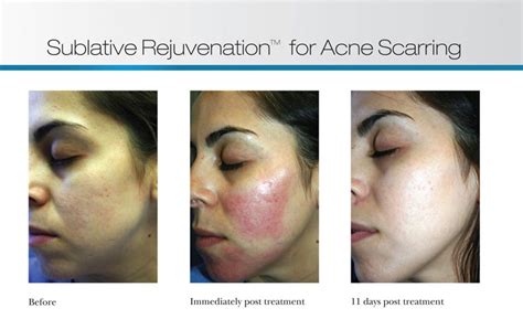 Ematrix Sublative Skin Rejuvenation Laser Skin Resurfacing Before