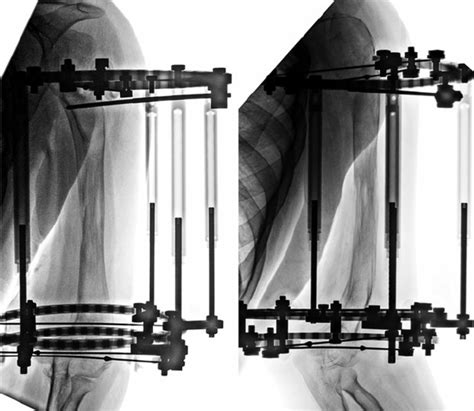 Ap And Lat Radiographs After Completion Of 14 Cm Of Humeral Lengthening