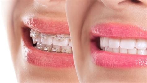 Traditional And Clear Braces Chic Dental