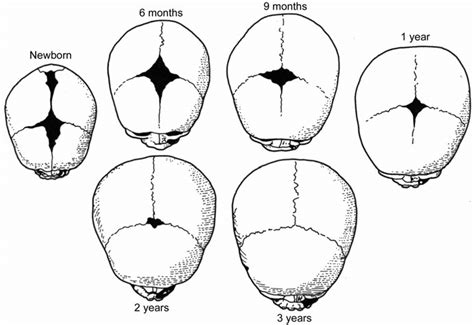 1 Developmental Stages Of Fontanelle Closure Between Birth And 3 Years