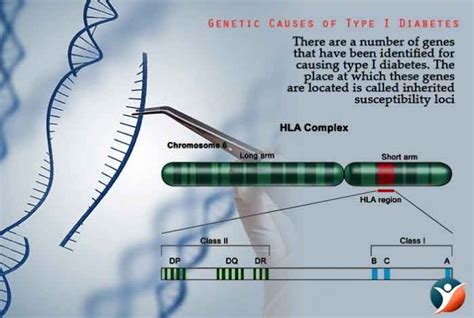 Genetic Causes Of Type 1 Diabetes Know More