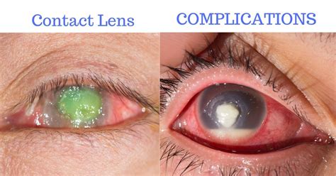 Complications Of Contact Lenses Board Certified Eye Doctors