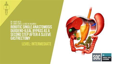 Ais Channel · Robotic Single Anastomosis Duodeno Ileal Bypass As A