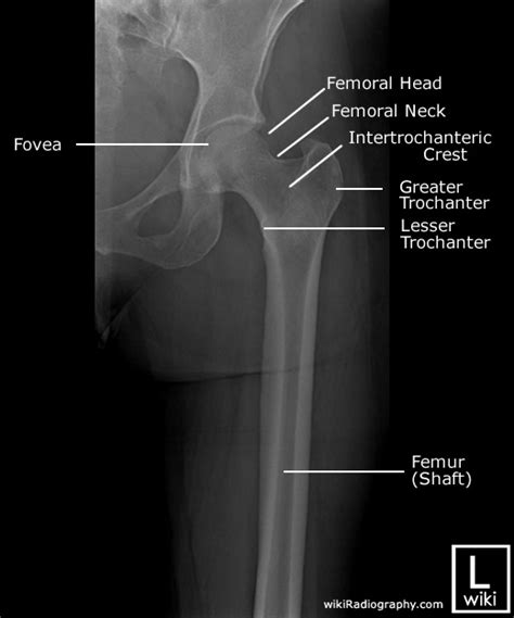 Femur Radiographic Anatomy Wikiradiography Medical Radiography The Best Porn Website