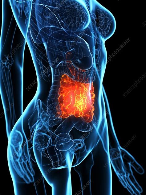 Diseased Small Intestine Illustration Stock Image F0271212