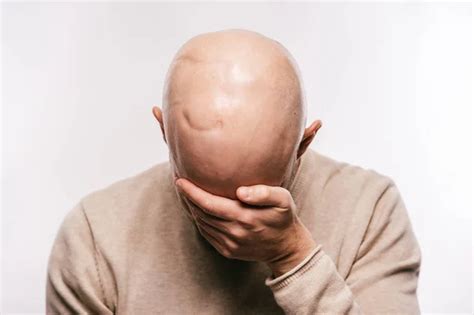 Bald Man Psychological Stress Struggling For Life Arter Brain Tumor
