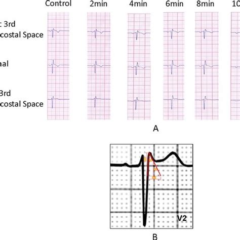 A Standard 12 Lead Ecg 4th Ics Leads V1v3 Sinus Rhythm Heart