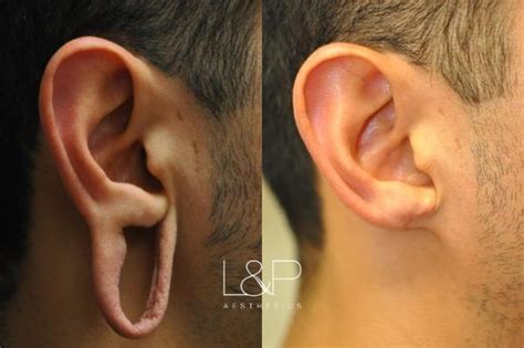 Earlobe Repair Before And After Photos Case 67 Palo Alto And San Jose