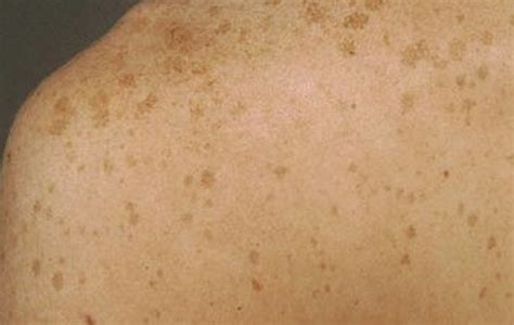 Liver Spots Pictures Face Skin Hands Causes Treatment