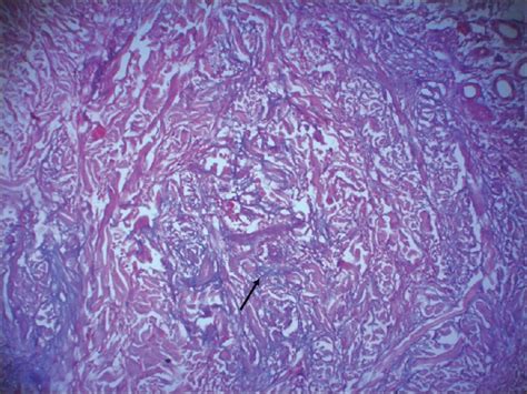 Isolated Unilateral Palisaded Neutrophilic And Granulomatous Dermatitis