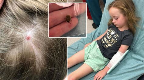 Mothers Tick Warning After Daughter Left Unable To Walk