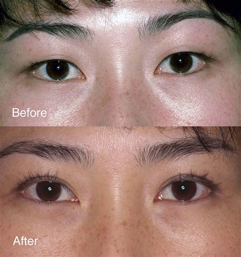 Case Studies Eyelid Surgery Beverly Hills Lidlift