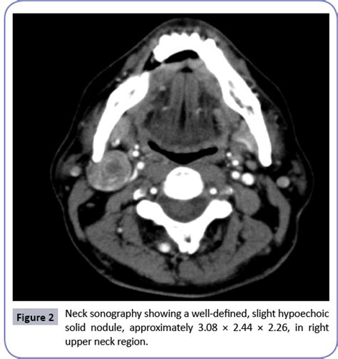 Pleomorphic Adenoma Of Ectopic Salivary Gland Tissue In The Upper Neck Insight Medical Publishing