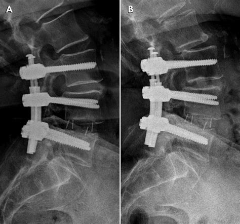 —S.S., 73 years old. Circumferential arthrodesis at L4-L5 was performed