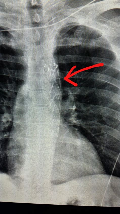 Chest Xray Aortic Stentgraft Placed By An Interventional