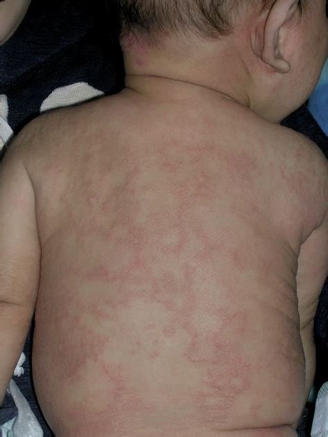 Annular Erythema And Papules In Infantile Atopic Dermatitis Html