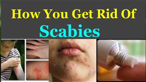 You will simply love this remedy! How You Can Get Rid Of Scabies - YouTube